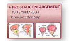Prostatic Enlargement   