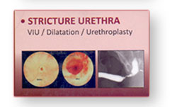 Urethroplasty   