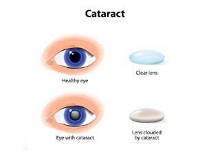 Cataract (Motibindu) Treatment 