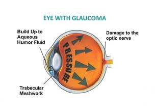 Glaucoma Treatment 