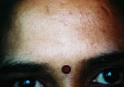 Dr. Bipin Deshpande, Dr. Bipin Deshpande Chaitanya Clinic Kothrud, Dr. Bipin Deshpande Near Cummins Circle Kothrud, Dr. Bipin Deshpande Dahanukar Colony Kothrud, Dr. Bipin Deshpande Kothrud Pune, Dr. Bipin Deshpande Pune, dermotologist, skin dermatologist, Best dermatologist in pune. Skin Specialist in kothrud pune, best Acne Treatments in pune
