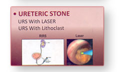 Kidney Stone 