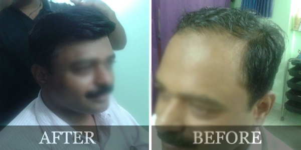 Innovation Care, Aundh, Pune | Hair Replacement, Non Surgical Hair Transplant Innovation Care, Aundh, Pune | Hair Replacement, Non Surgical Hair Transplant