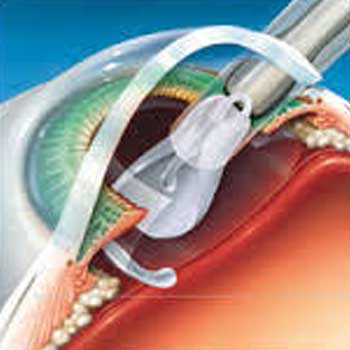 Stichless Cataract Surgery 