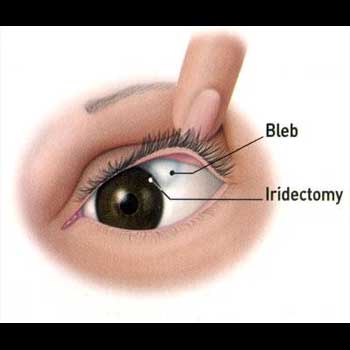 Glaucoma Surgery