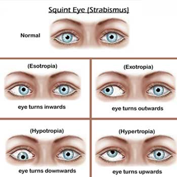 Squint Surgery