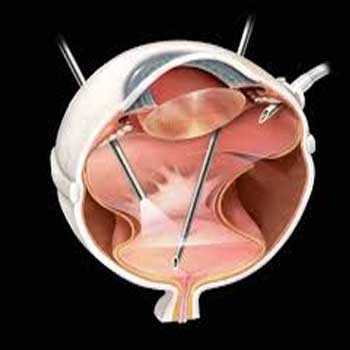 Diabetic Retinal Laser Surgery