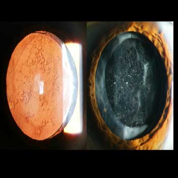 YAG Laser Surgery 