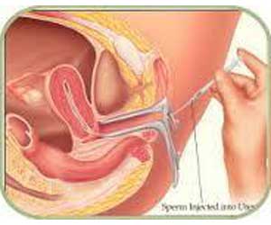 INFERTILITY & IUI