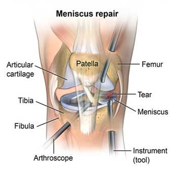 Arthroscopy