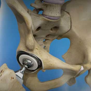 Hip Replacement