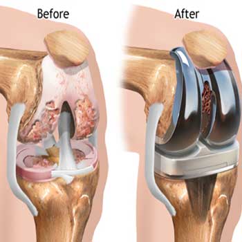 Knee Replacement7