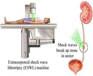 Extracorporeal Shock Wave Lithotripsy (ESWL) 